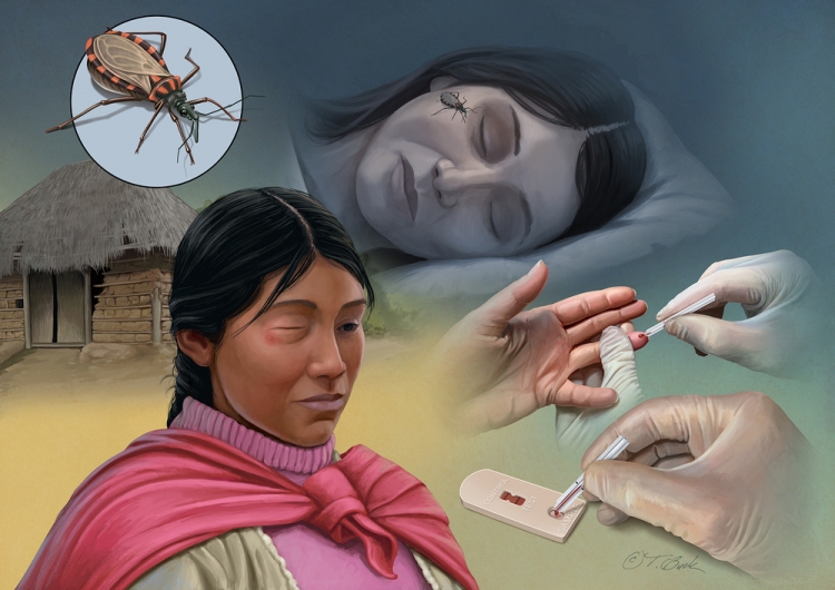 In a period of reduced international travel due to COVID19, MSF challenged medical illustrator Todd Buck to create six high quality custom medical and scientific illustrations that depict some of the most life-threatening and neglected tropical diseases that MSF treats.
MSF has been providing direct care to patients with neglected tropical diseases (NTDs) for more than thirty years, with a focus on the most deadly and overlooked diseases in this group of illnesses. In that time, hundreds of thousands of patients have been treated who otherwise may not have survived. Many had life-threatening parasitic infections such as kala azar (visceral leishmaniasis or VL), Chagas disease (American trypanosomiasis) or sleeping sickness (human African trypanosomiasis). Some were affected by noma, a deadly bacterial disease so neglected that it is not yet recognised as an NTD. Others were the victims of snakebite envenoming, the medical condition resulting from a snakebite, which causes more death and disability than any other NTD. 
Todd Buck is a fellow of the Association of Medical Illustrators (AMI) in the United States, has served on its Board of Governors. He is a Board Certified Medical Illustrator (CMI) and Professor of Illustration at Northern Illinois University School of Art & Design.